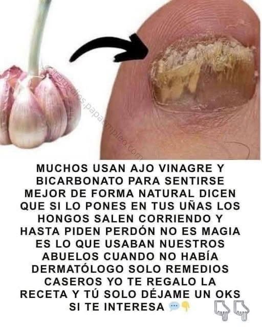 Hongos en las Uñas: Qué Funciona Realmente y Cómo Cuidarlas con Seguridad