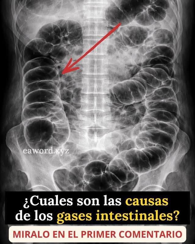 Los gases intestinales: lo que tu cuerpo intenta decirte (y casi nadie explica bien).