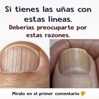 ¿Tienes líneas en las uñas? debes solucionarlo – Bienvenido al Hogar