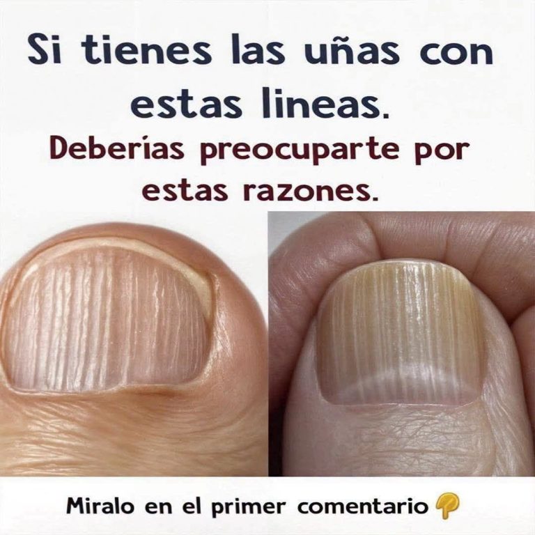 ¿Tienes líneas en las uñas? debes solucionarlo – Bienvenido al Hogar