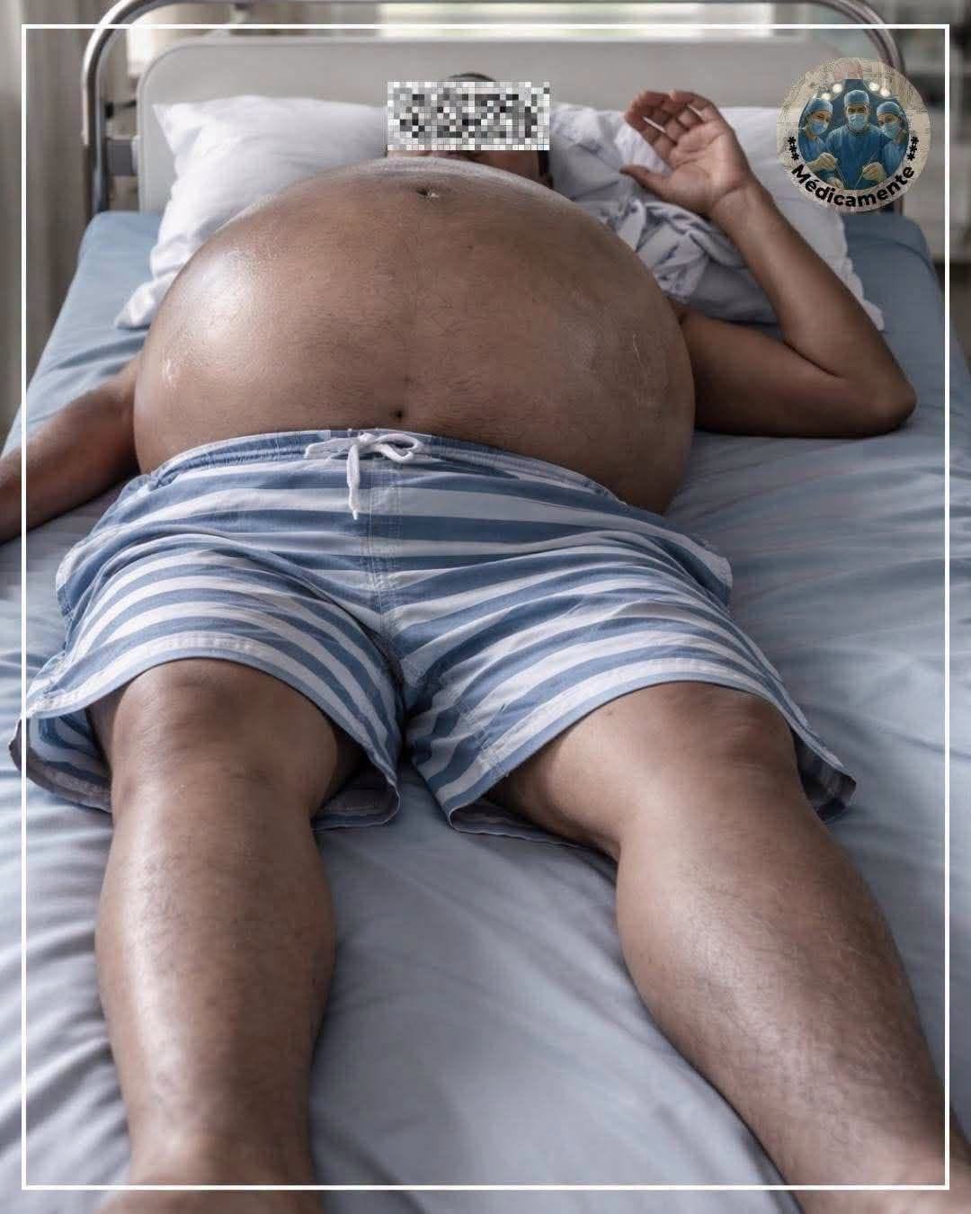 La Señal Silenciosa Que Aparece en el Abdomen y Puede Advertir un Grave Problema de Salud
