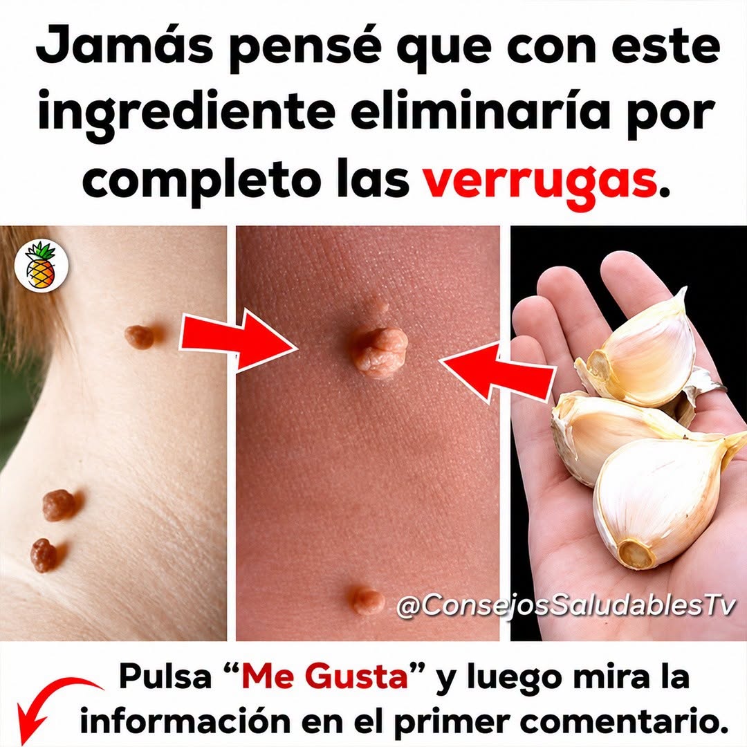 LAS VERRUGAS SE CAEN COMO HOJAS CON SOLO APLICAR ESTE TRATAMIENTO CASERO