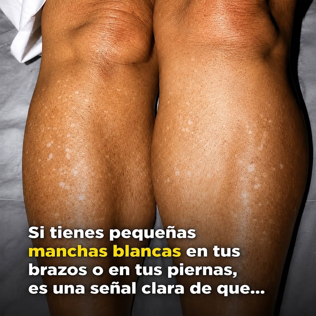 ¿Qué hay detrás de esas manchas blancas en tu piel?